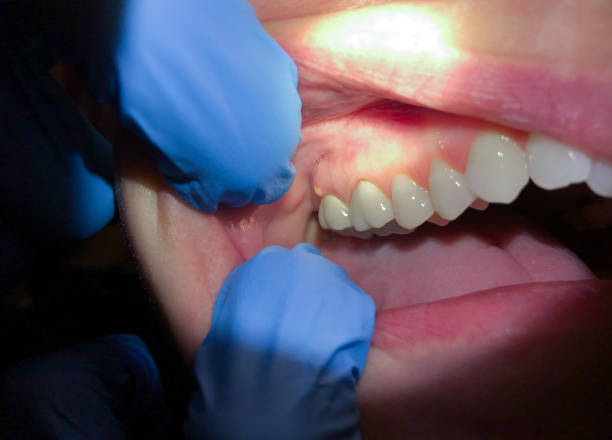 Best Broken or Cracked Tooth Emergency Dentist in Saltville, VA
