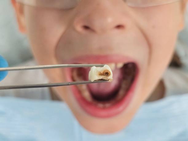Best Emergency Dentist for Knocked-Out Tooth in Saltville, VA